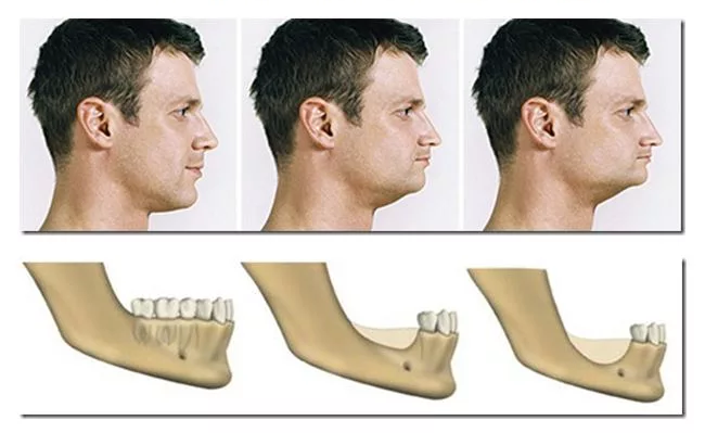 problems when not getting a dental implant after tooth loss
