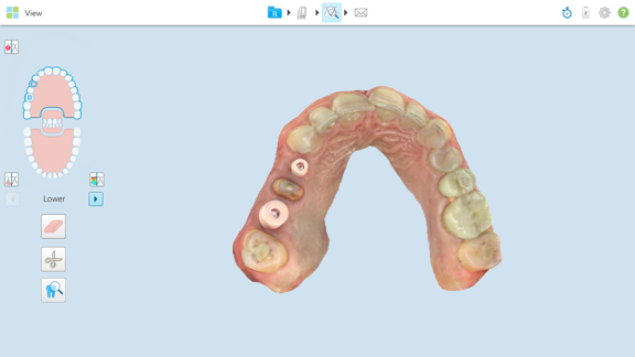 3D digital intraoral scan used for dental implant planning